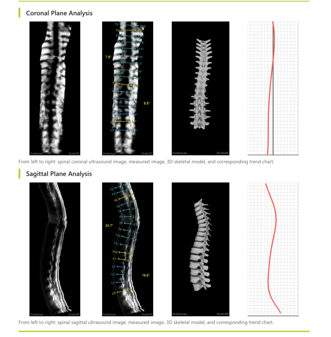 Scoliscan® 3D 脊柱側彎超聲波掃描分析報告