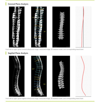 Scoliscan® 3D 脊柱側彎超聲波掃描分析報告